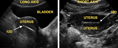 iud long and short axis