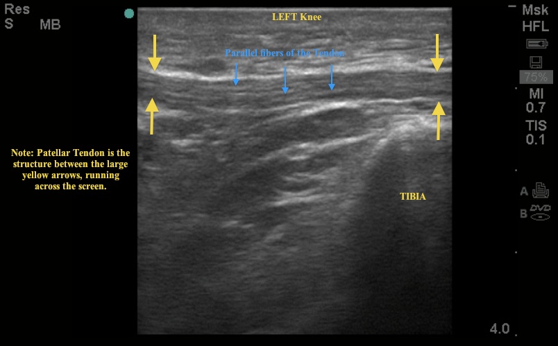 leftpatellartendon