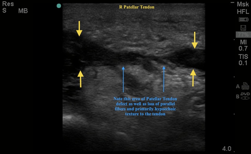 rightpatellartendon