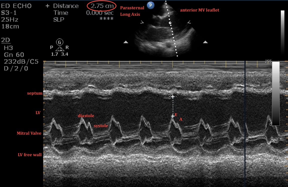 Ultrasound Physics Scanning Modes M Mode 