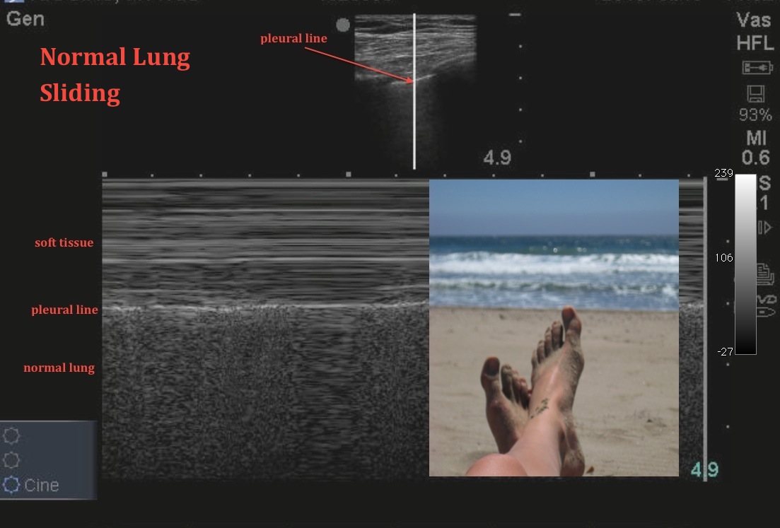 M-Mode for Pneumothorax  Emory School of Medicine