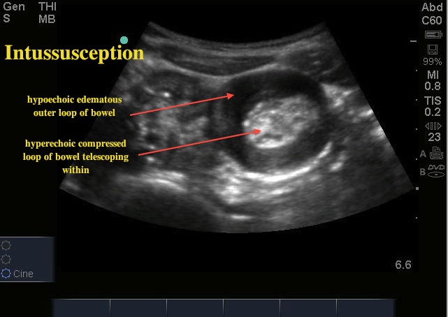 insussusception1