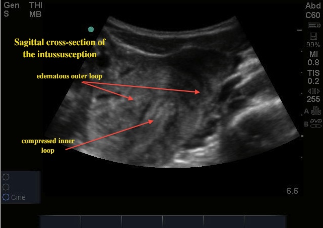 intussusception2