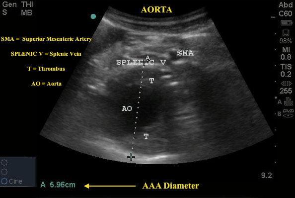 ruptured abdominal aortic aneurysm ultrasound