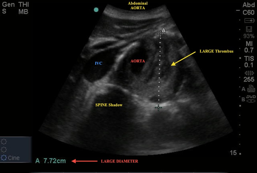 aortic anuerism
