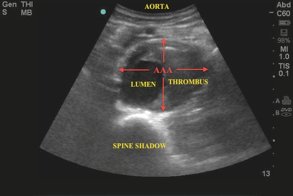 Aortic Aneurysm With Belly Pain Emory School Of Medicine