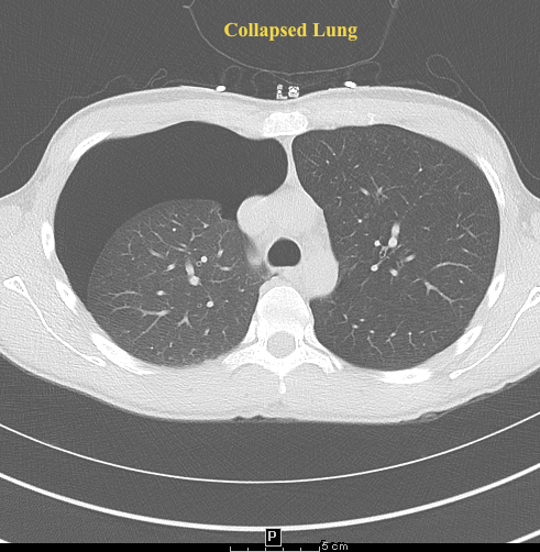 M-Mode for Pneumothorax  Emory School of Medicine