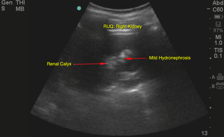 mild hydronephrosis ultrasound