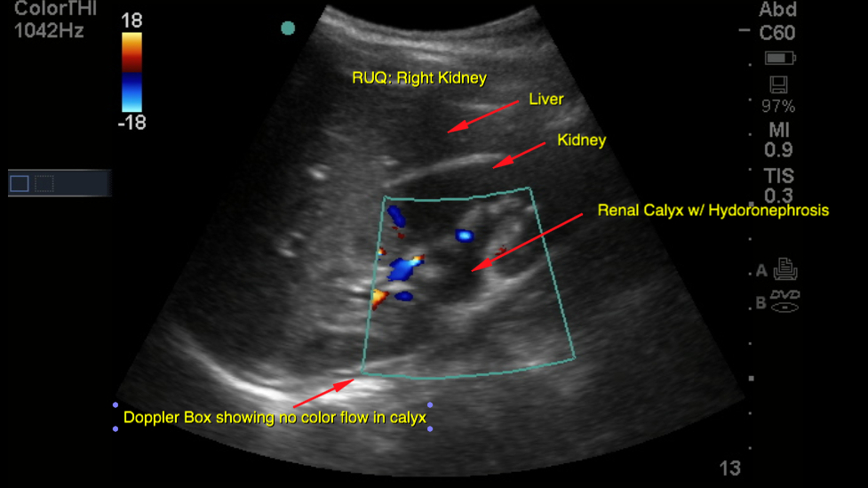 mild hydronephrosis ultrasound