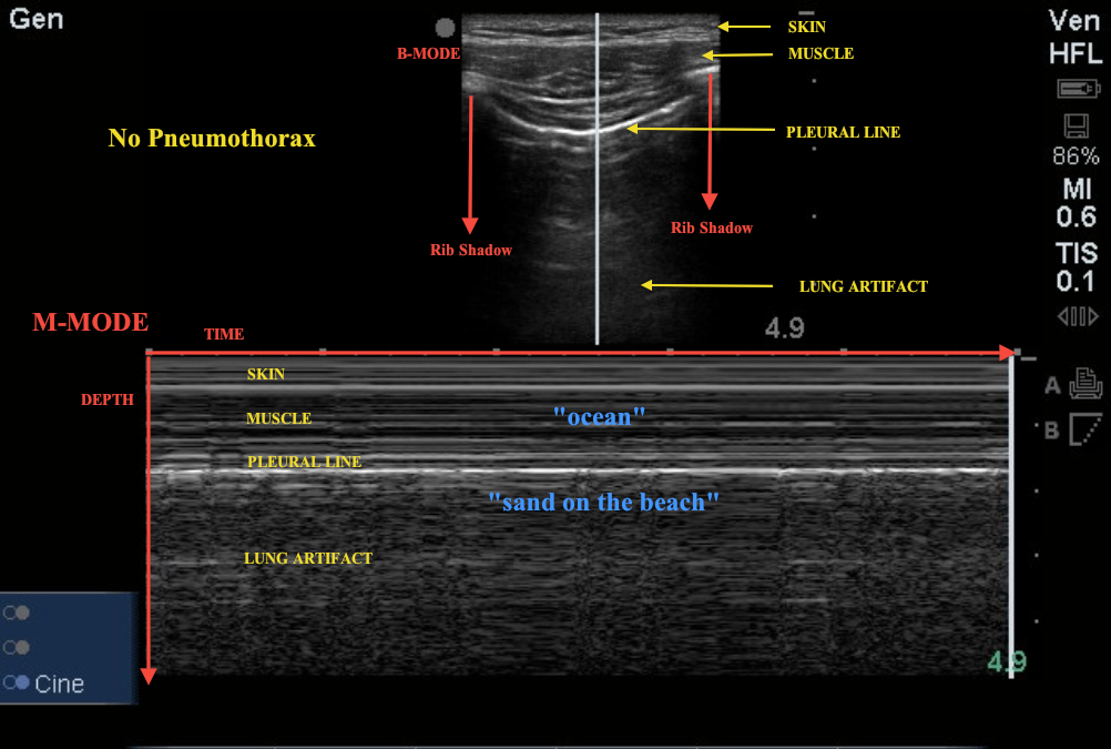 picture of pneumothorax m mode ultrasound