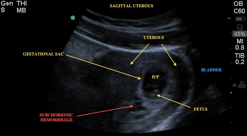 The significance of ultrasound features of sub-chorionic