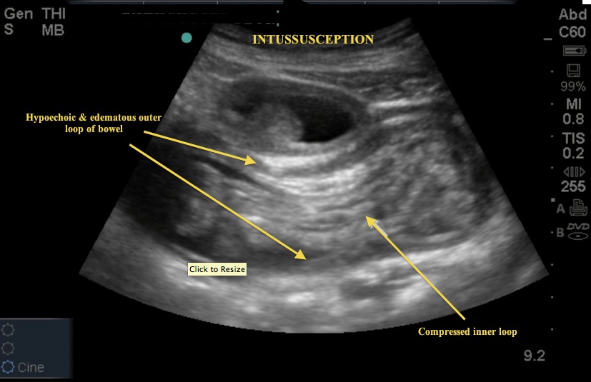 intussusception target sign