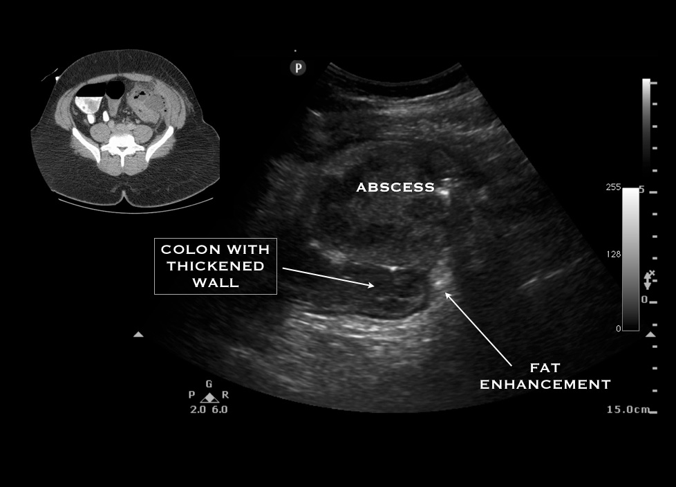 diverticular abscess