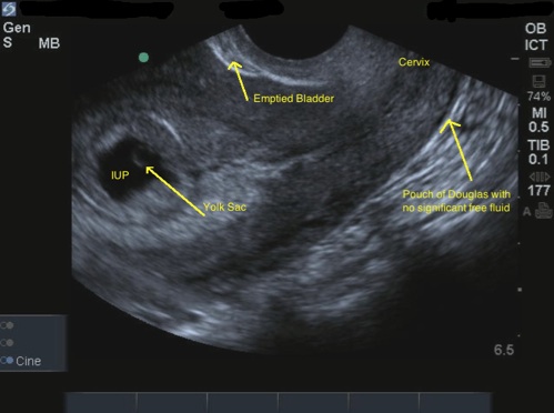 Normal early pregnancy imaging