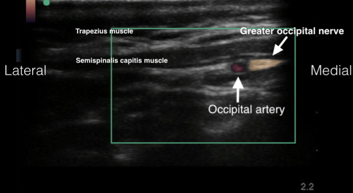 Occipital Nerve Block Emory School Of Medicine 7396