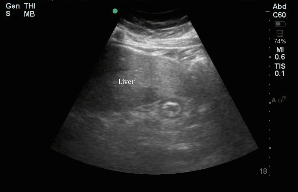 normal liver ultrasound