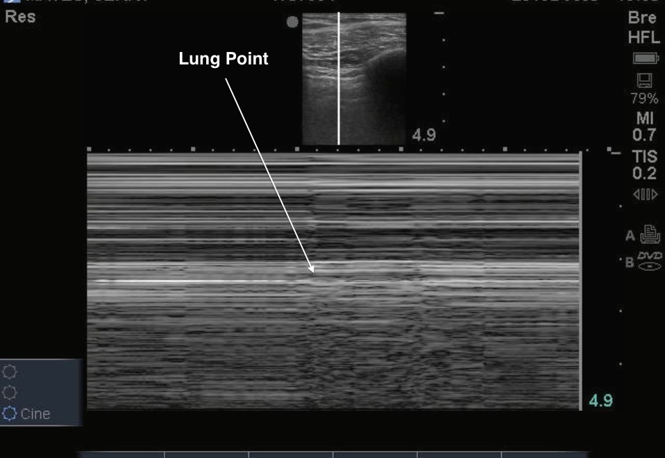 lung point