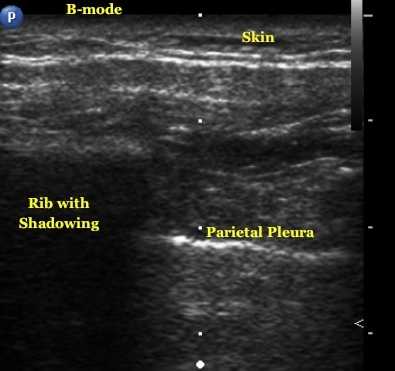 Diagnosing Pneumothorax  Emory School of Medicine