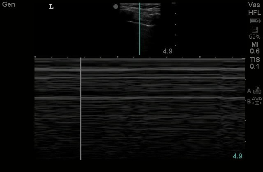 M-Mode for Pneumothorax  Emory School of Medicine