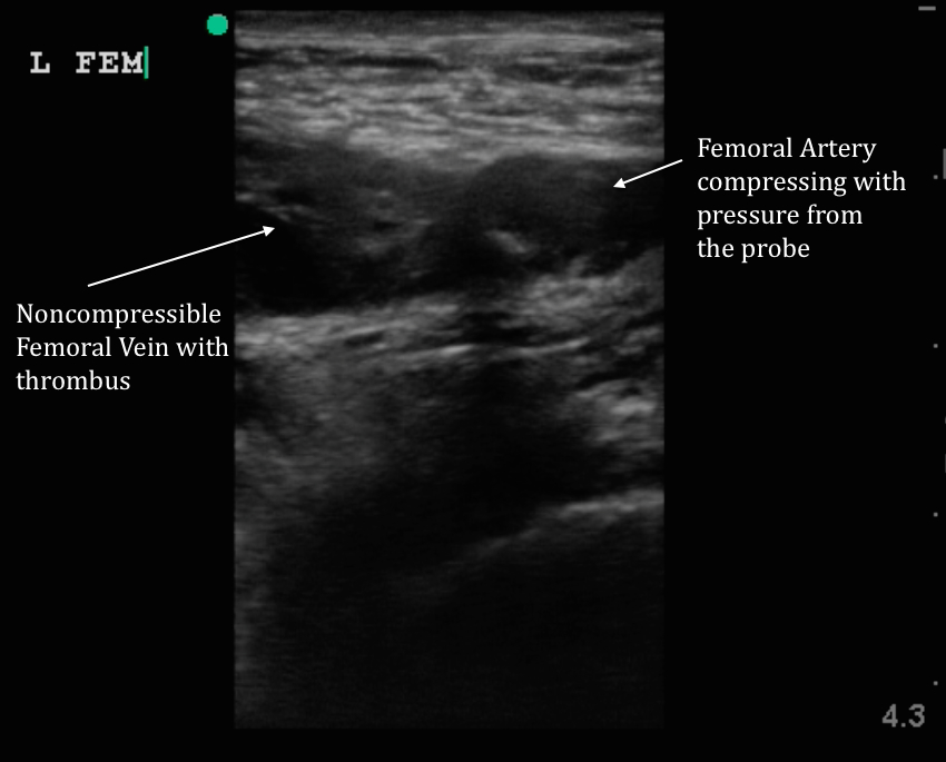 blood clot in arm ultrasound