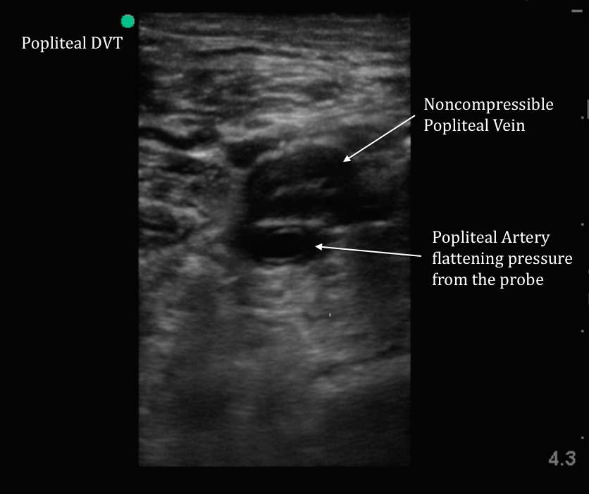 popliteal vein ultrasound