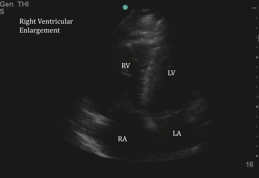 Strain Echocardiography in Acute Cardiovascular Diseases - The