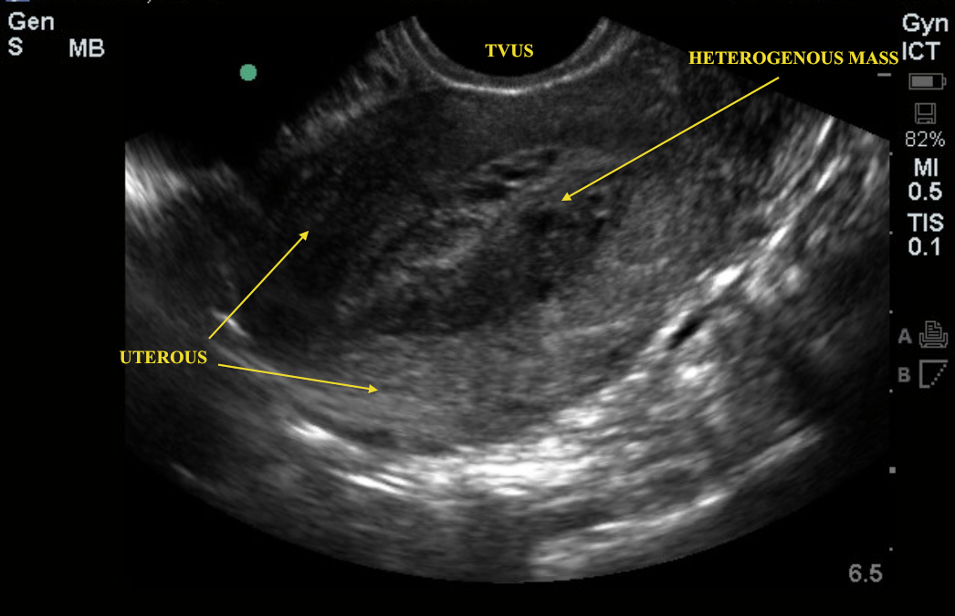 molarpregnancy