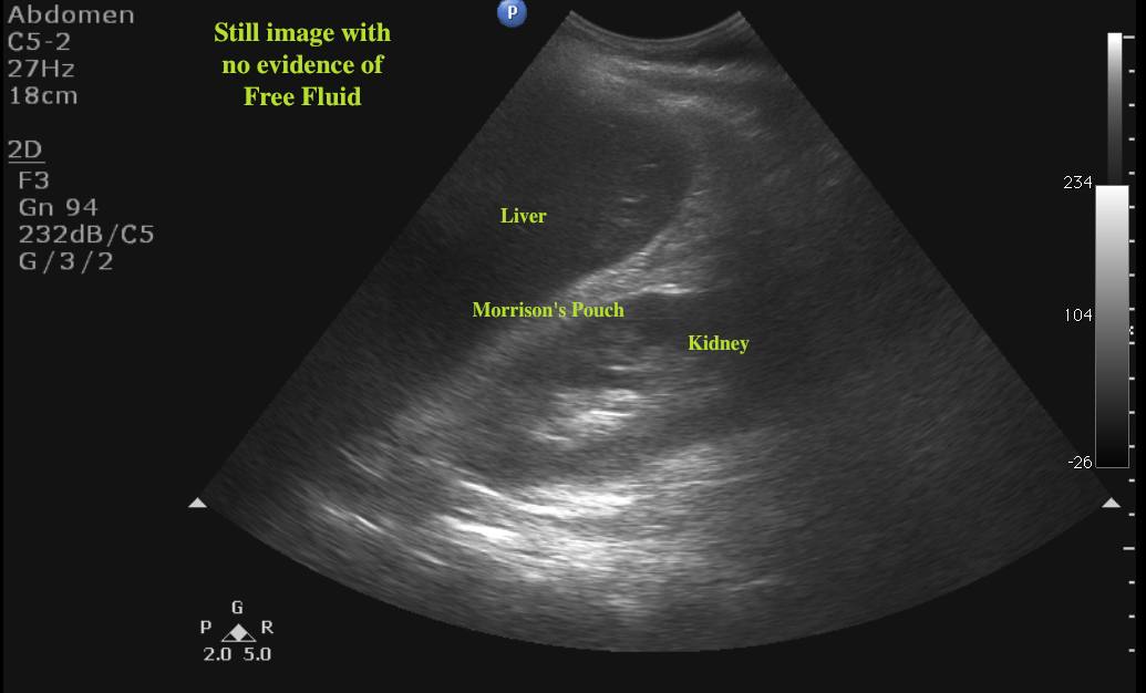 perforated gallbladder ultrasound