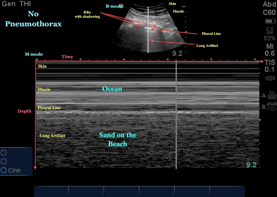 picture of pneumothorax m mode ultrasound