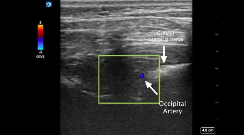 Occipital Nerve Block Emory School Of Medicine 9606