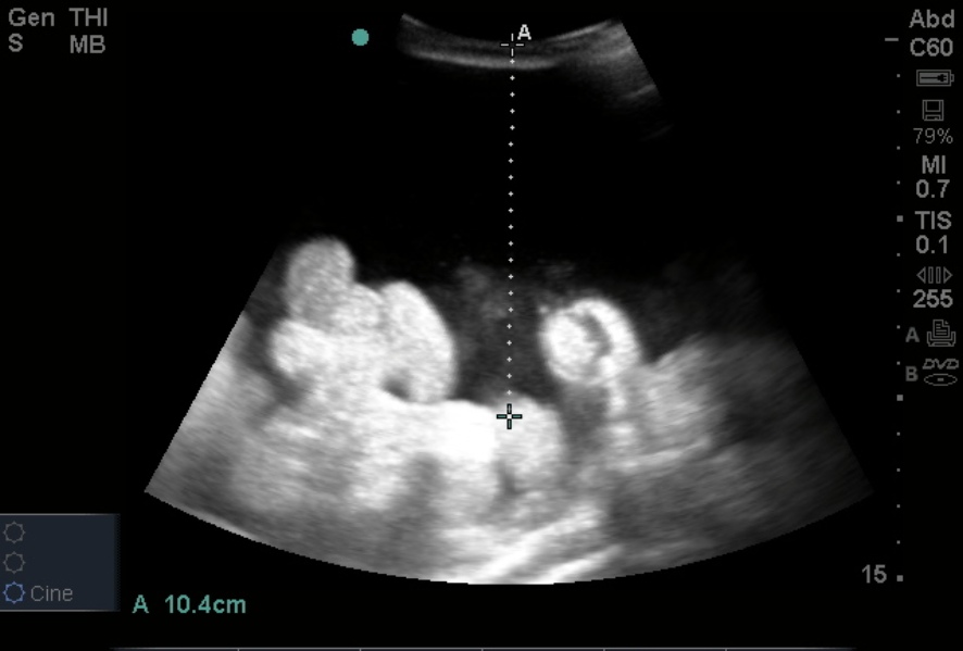 Paracentesis Procedure