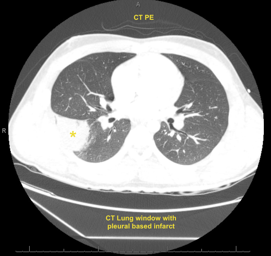 PE R lung infarct