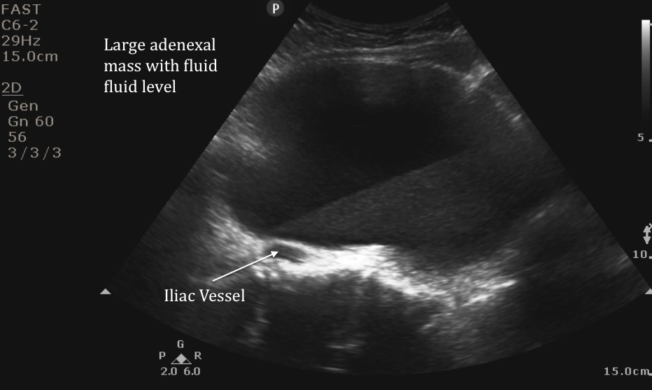 pelvic2