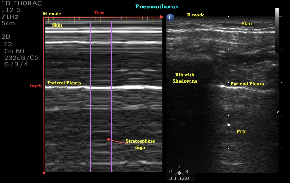 pneumothorax