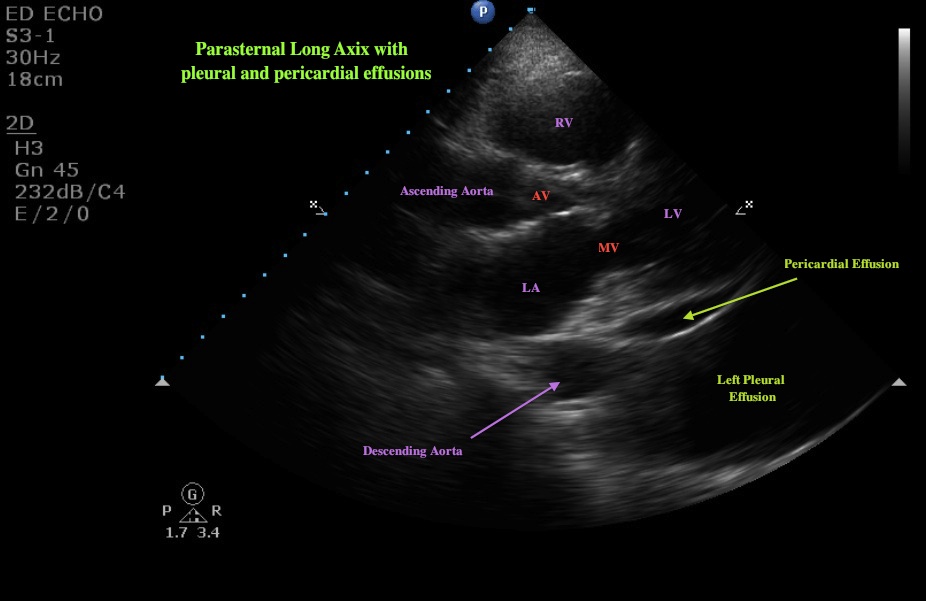 pericardial effusion ultrasound