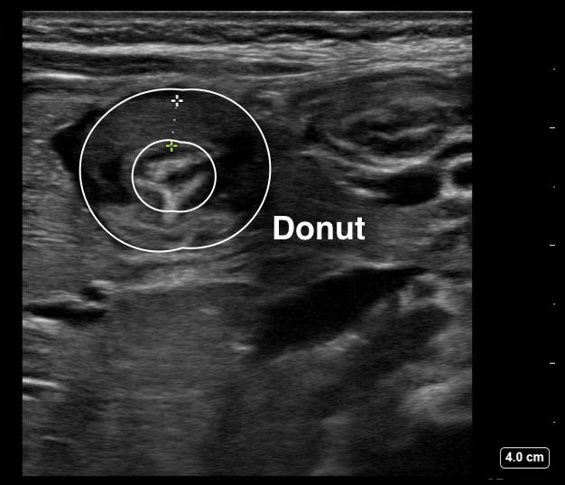 pyloric stenosis shoulder sign