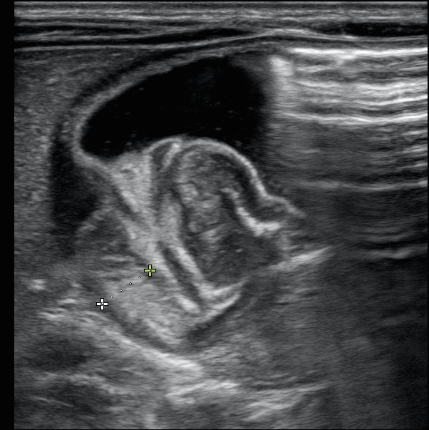 pyloric stenosis upper gi series