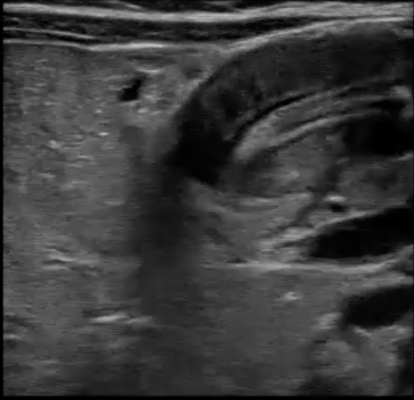 pyloric stenosis ultrasound