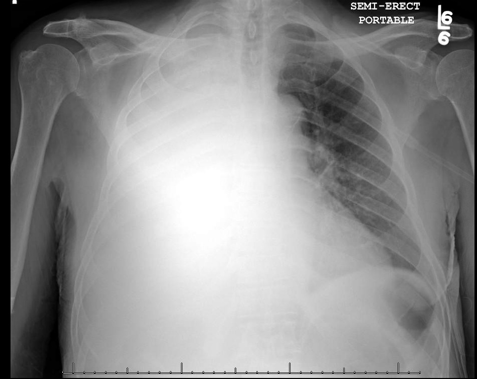 lung consolidation vs pleural effusion