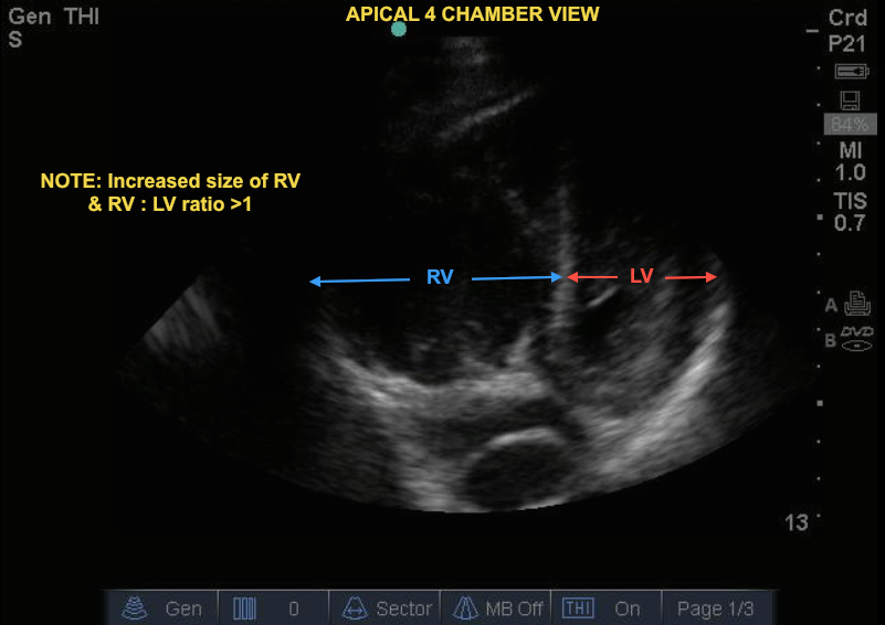 Hennepin Ultrasound  Right Ventricular Strain in Pulmonary Embolism