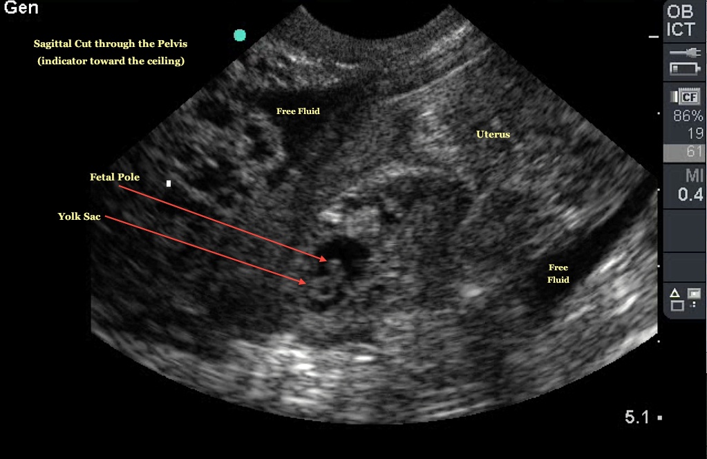 ruptured ectopic pregnancy ultrasound