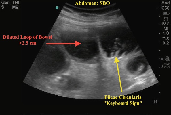 small bowel obstruction