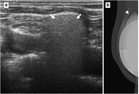 Mammogram With Breast Implants