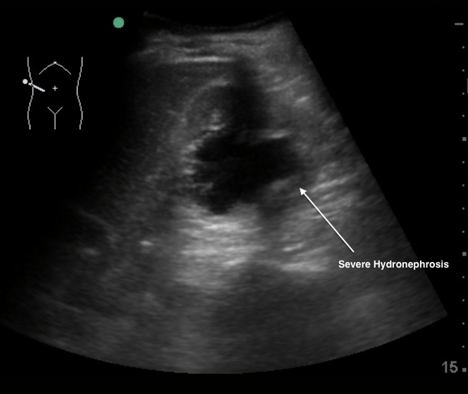 mild hydronephrosis ultrasound