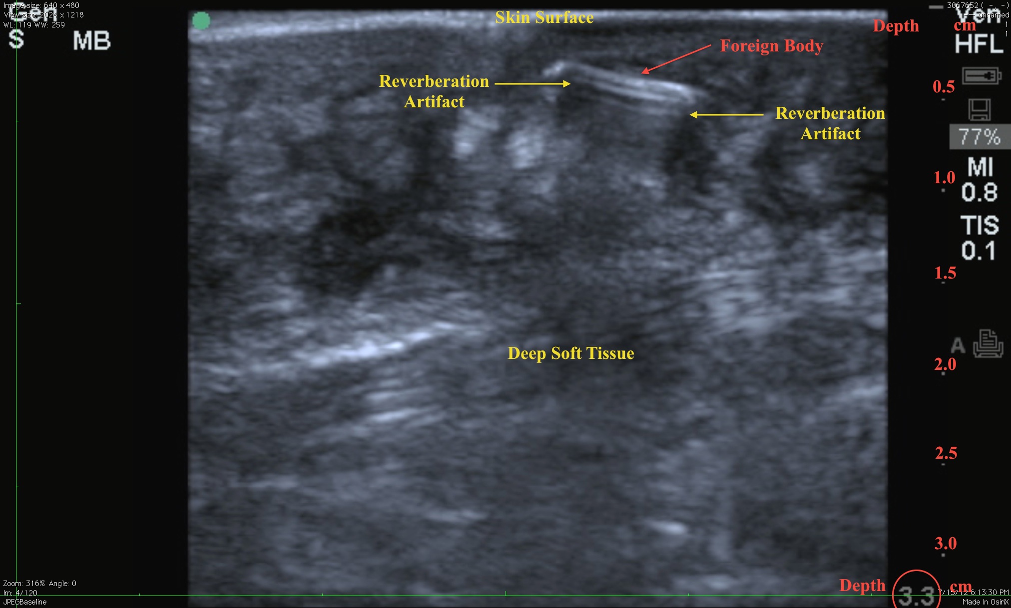 Soft Tissue Ultrasound 