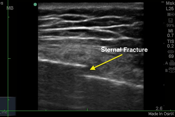 XR Sternal fracture