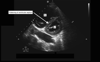 Hennepin Ultrasound  Right Ventricular Strain in Pulmonary Embolism