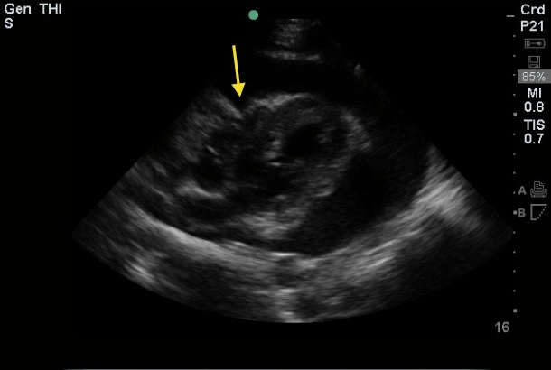 cardiac tamponade echo