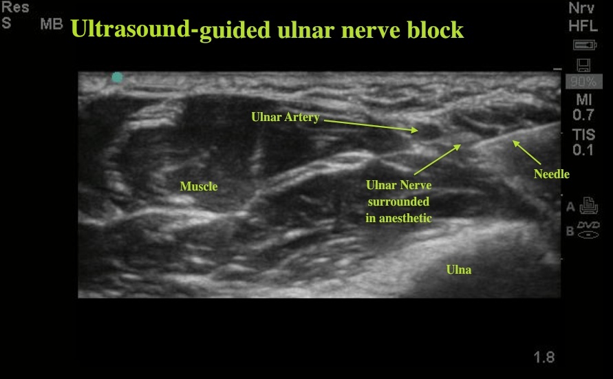 Ulnar Nerve Block Ultrasound