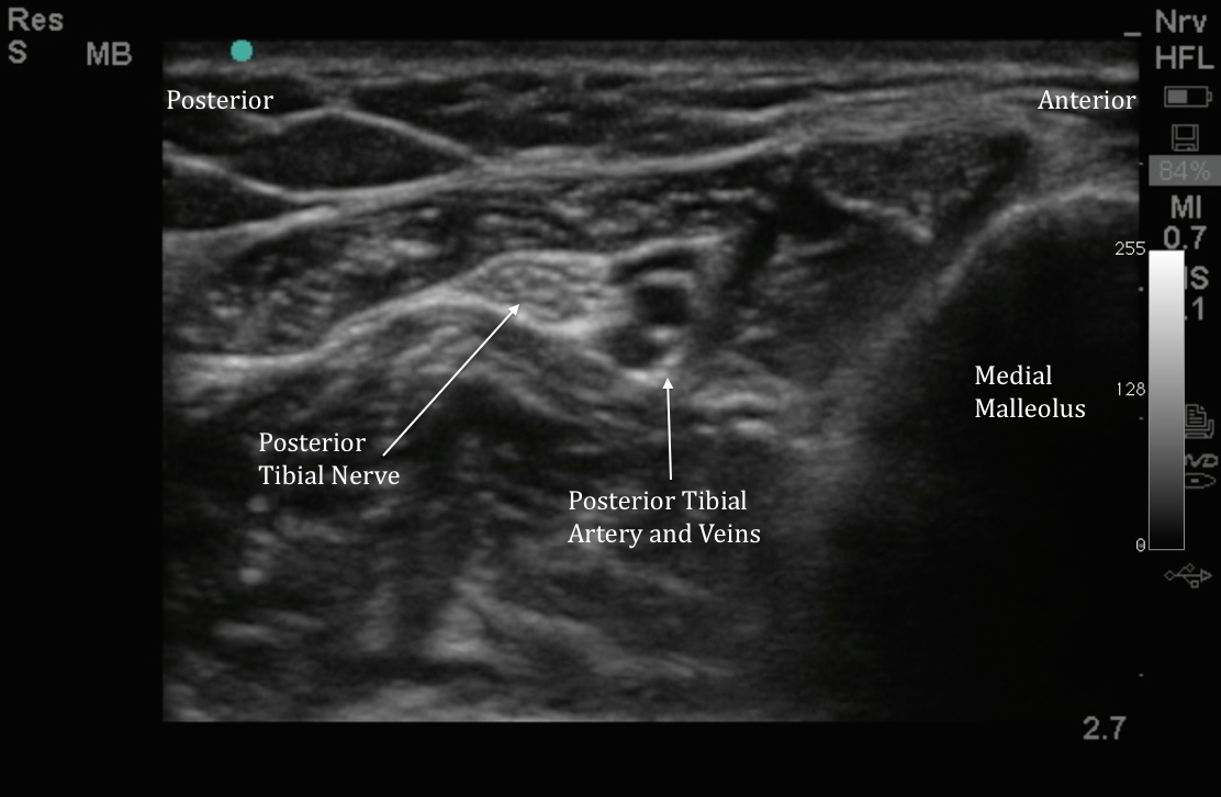 Tibial Nerve Block Ultrasound - vrogue.co